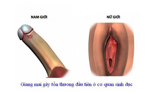 Bệnh giang mai là gì? Dấu hiệu triệu chứng của bệnh giang mai